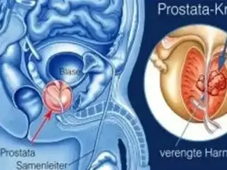 Prostata: neue Erkenntnisse zur Untersuchung und zum PSA-Wert