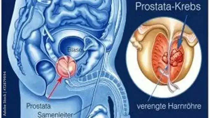 Prostata: neue Erkenntnisse zur Untersuchung und zum PSA-Wert