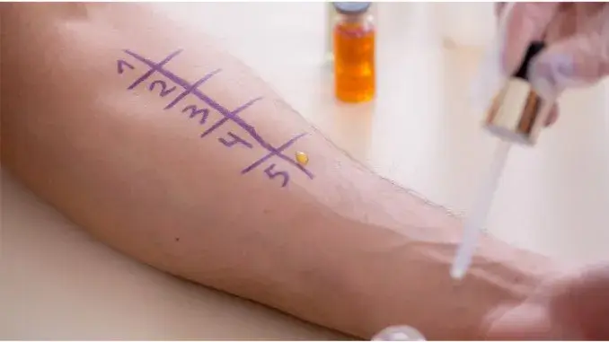 Allergietest - AOK Umfrage: Ein Drittel hat eine Allergie