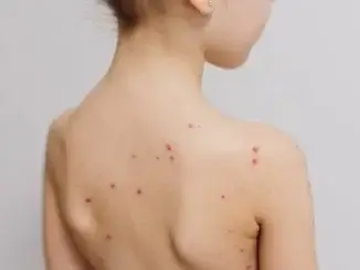 Windpocken: Rückgang der Fälle im Kreis RE